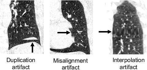 Figure 1 for Geodesic Density Regression for Correcting 4DCT Pulmonary Respiratory Motion Artifacts