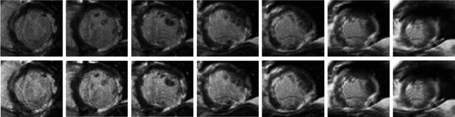 Figure 4 for A Comprehensive 3-D Framework for Automatic Quantification of Late Gadolinium Enhanced Cardiac Magnetic Resonance Images