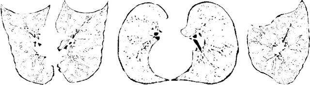 Figure 4 for Extraction of airway trees using multiple hypothesis tracking and template matching