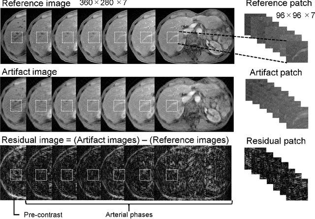 Figure 1 for Method for motion artifact reduction using a convolutional neural network for dynamic contrast enhanced MRI of the liver