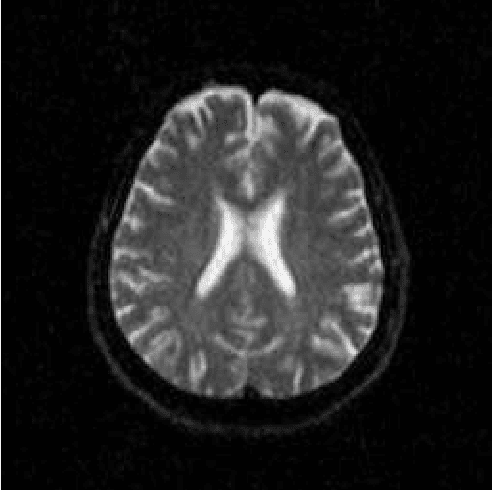 Figure 1 for Dialectical Multispectral Classification of Diffusion-Weighted Magnetic Resonance Images as an Alternative to Apparent Diffusion Coefficients Maps to Perform Anatomical Analysis