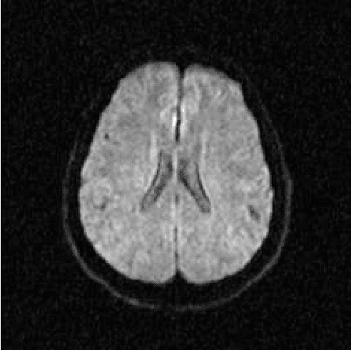 Figure 3 for Dialectical Multispectral Classification of Diffusion-Weighted Magnetic Resonance Images as an Alternative to Apparent Diffusion Coefficients Maps to Perform Anatomical Analysis