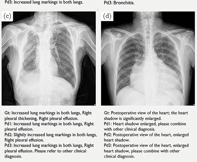 Figure 4 for Automated Radiological Report Generation For Chest X-Rays With Weakly-Supervised End-to-End Deep Learning