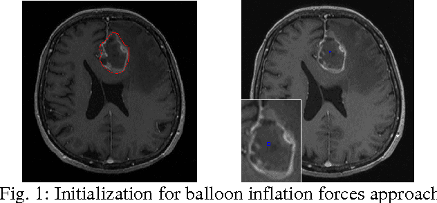 Figure 1 for A Comparison of Two Human Brain Tumor Segmentation Methods for MRI Data