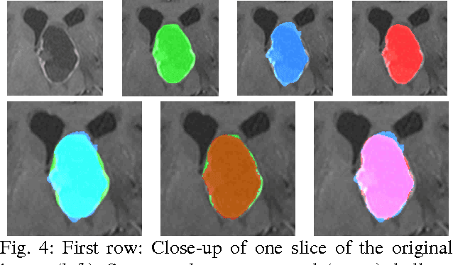 Figure 4 for A Comparison of Two Human Brain Tumor Segmentation Methods for MRI Data