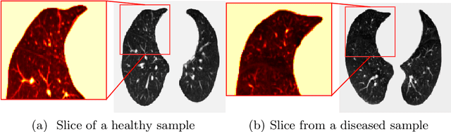 Figure 3 for COPD Classification in CT Images Using a 3D Convolutional Neural Network