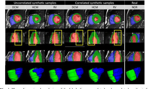 Figure 4 for Pathology Synthesis of 3D Consistent Cardiac MR Im-ages Using 2D VAEs and GANs