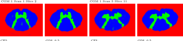 Figure 3 for Spinal Cord Gray Matter-White Matter Segmentation on Magnetic Resonance AMIRA Images with MD-GRU