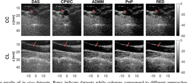 Figure 3 for Inverse Problem of Ultrasound Beamforming with Denoising-Based Regularized Solutions