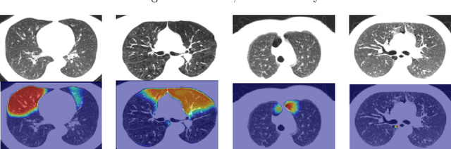 Figure 2 for Deep Clustering Activation Maps for Emphysema Subtyping