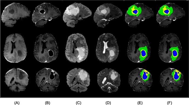 Figure 3 for Prediction of MGMT Methylation Status of Glioblastoma using Radiomics and Latent Space Shape Features