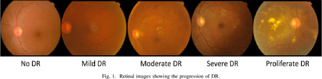 Figure 1 for Conversion and Implementation of State-of-the-Art Deep Learning Algorithms for the Classification of Diabetic Retinopathy