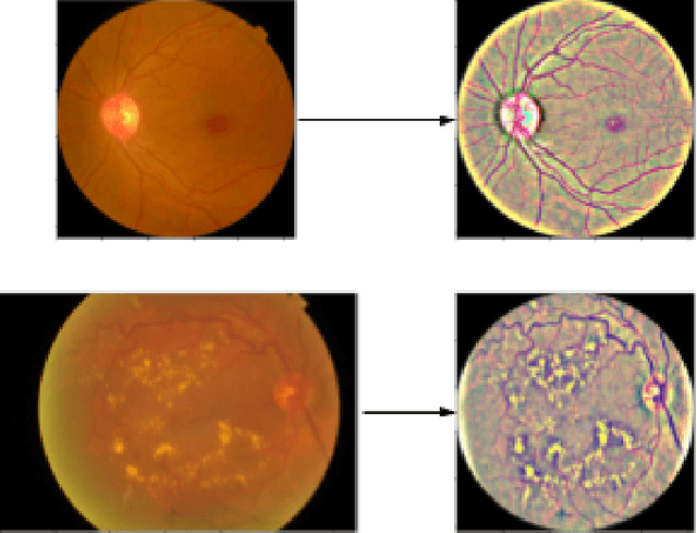 Figure 3 for Conversion and Implementation of State-of-the-Art Deep Learning Algorithms for the Classification of Diabetic Retinopathy