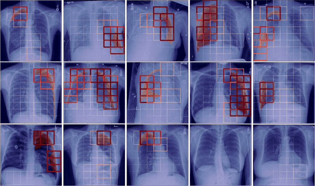 Figure 3 for Localization of Critical Findings in Chest X-Ray without Local Annotations Using Multi-Instance Learning
