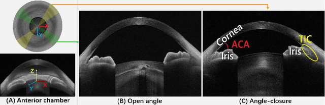 Figure 1 for Reconstruction and Quantification of 3D Iris Surface for Angle-Closure Glaucoma Detection in Anterior Segment OCT