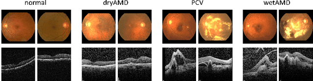 Figure 1 for Learning Two-Stream CNN for Multi-Modal Age-related Macular Degeneration Categorization