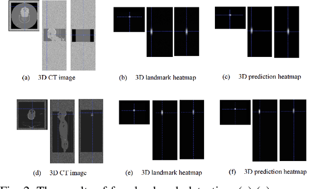 Figure 2 for Human Recognition Using Face in Computed Tomography