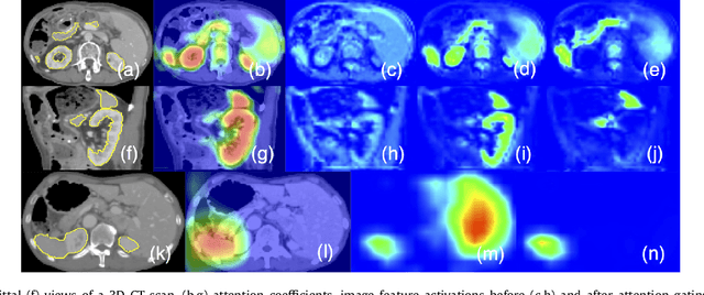 Figure 1 for Attention Gated Networks: Learning to Leverage Salient Regions in Medical Images