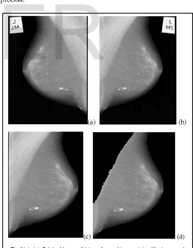 Figure 4 for Automatic Mammogram image Breast Region Extraction and Removal of Pectoral Muscle