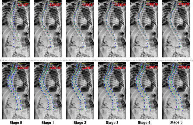 Figure 4 for Accurate Scoliosis Vertebral Landmark Localization on X-ray Images via Shape-constrained Multi-stage Cascaded CNNs
