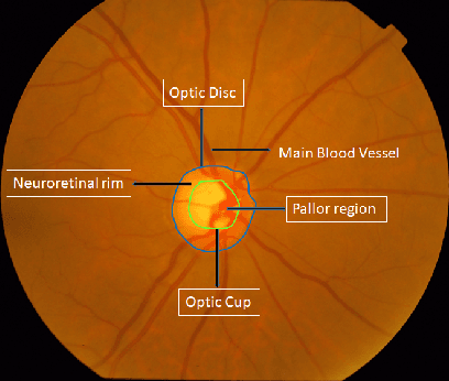 Figure 1 for Deep Learning based Framework for Automatic Diagnosis of Glaucoma based on analysis of Focal Notching in the Optic Nerve Head