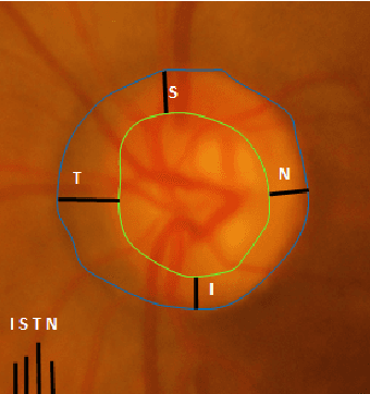 Figure 3 for Deep Learning based Framework for Automatic Diagnosis of Glaucoma based on analysis of Focal Notching in the Optic Nerve Head