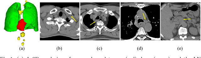 Figure 1 for Lymph Node Gross Tumor Volume Detection in Oncology Imaging via Relationship Learning Using Graph Neural Network