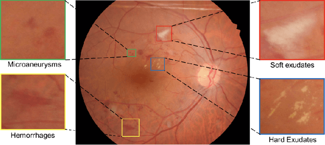 Figure 1 for Improving Lesion Segmentation for Diabetic Retinopathy using Adversarial Learning