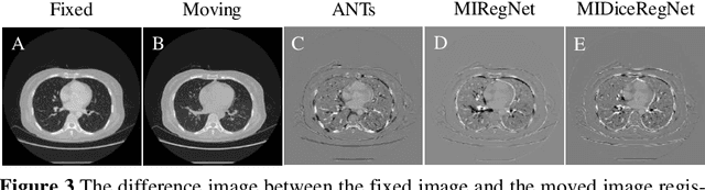 Figure 3 for Mutual information neural estimation in CNN-based end-to-end medical image registration