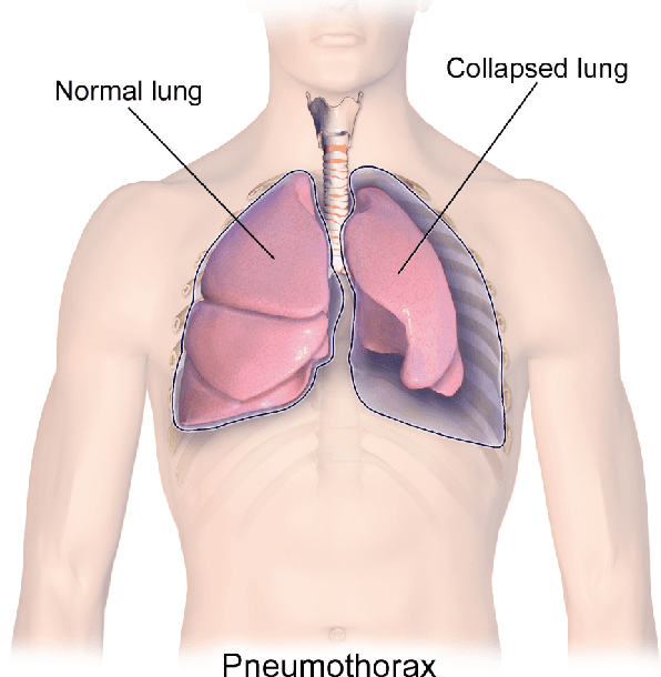 Figure 1 for Searching for Pneumothorax in X-Ray Images Using Autoencoded Deep Features