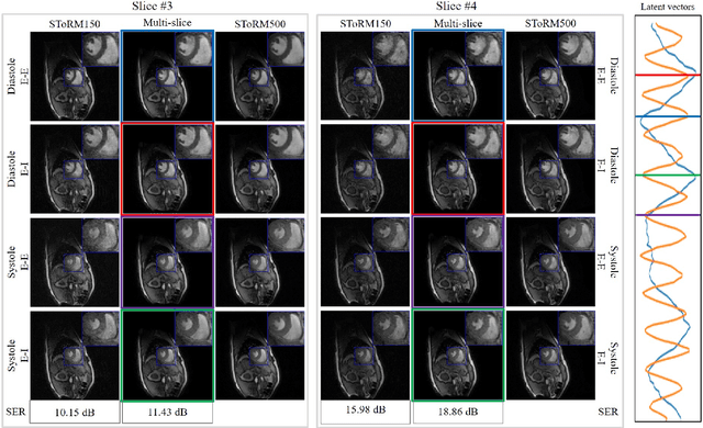 Figure 3 for Alignment & joint recovery of multi-slice dynamic MRI using deep generative manifold model