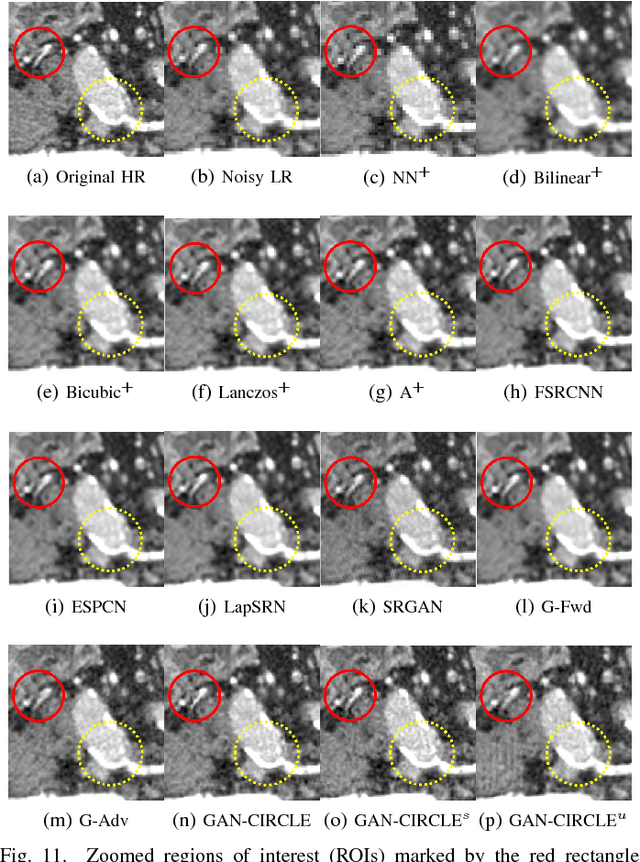 Figure 3 for CT Super-resolution GAN Constrained by the Identical, Residual, and Cycle Learning Ensemble