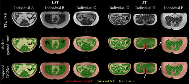 Figure 4 for Fully Automated and Standardized Segmentation of Adipose Tissue Compartments by Deep Learning in Three-dimensional Whole-body MRI of Epidemiological Cohort Studies