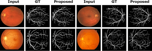 Figure 3 for Adversarial Learning with Multiscale Features and Kernel Factorization for Retinal Blood Vessel Segmentation