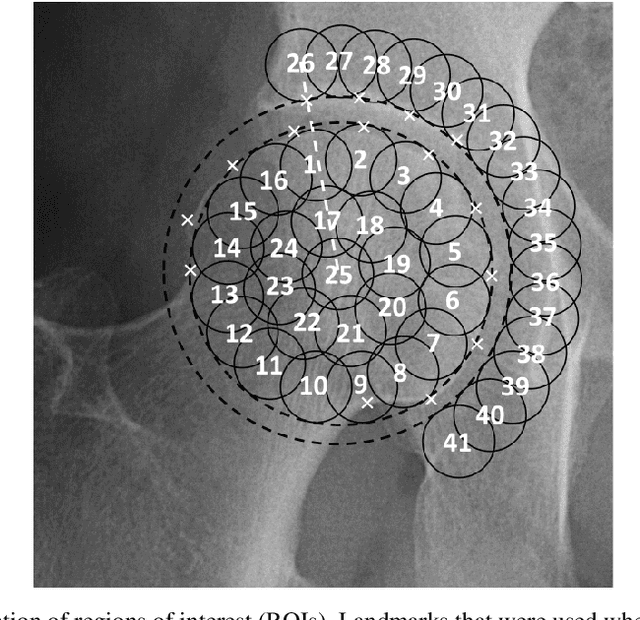 Figure 3 for Bone Texture Analysis for Prediction of Incident Radio-graphic Hip Osteoarthritis Using Machine Learning: Data from the Cohort Hip and Cohort Knee (CHECK) study