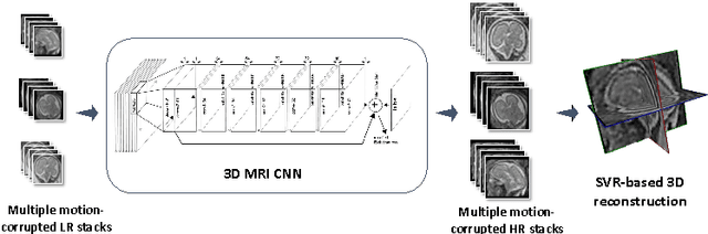 Figure 1 for Context-Sensitive Super-Resolution for Fast Fetal Magnetic Resonance Imaging