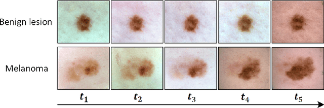 Figure 1 for Melanoma Diagnosis with Spatio-Temporal Feature Learning on Sequential Dermoscopic Images