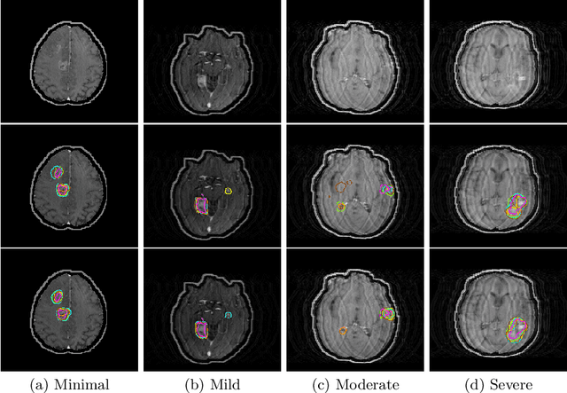 Figure 1 for Assessing Lesion Segmentation Bias of Neural Networks on Motion Corrupted Brain MRI