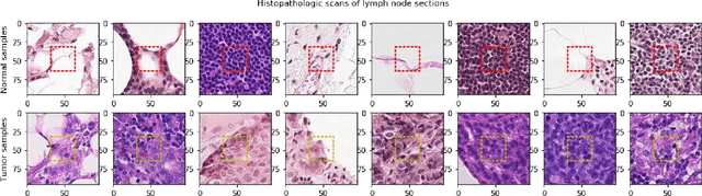 Figure 1 for Boosted EfficientNet: Detection of Lymph Node Metastases in Breast Cancer Using Convolutional Neural Network