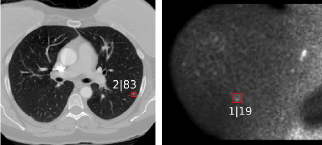 Figure 1 for Retina U-Net: Embarrassingly Simple Exploitation of Segmentation Supervision for Medical Object Detection