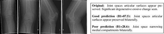 Figure 3 for Automated Knee X-ray Report Generation