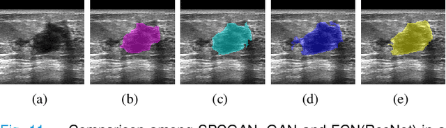 Figure 3 for Automated Segmentation of Lesions in Ultrasound Using Semi-pixel-wise Cycle Generative Adversarial Nets