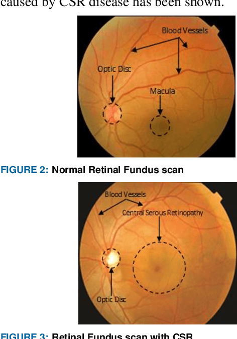 Figure 3 for Recent Developments in Detection of Central Serous Retinopathy through Imaging and Artificial Intelligence Techniques A Review