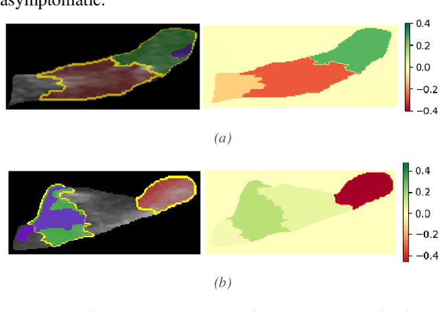 Figure 4 for Stratification of carotid atheromatous plaque using interpretable deep learning methods on B-mode ultrasound images
