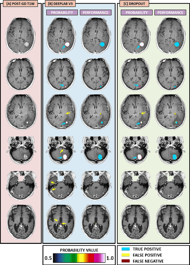 Figure 4 for Handling Missing MRI Input Data in Deep Learning Segmentation of Brain Metastases: A Multi-Center Study