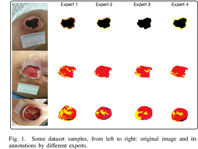 Figure 1 for ComplexWoundDB: A Database for Automatic Complex Wound Tissue Categorization