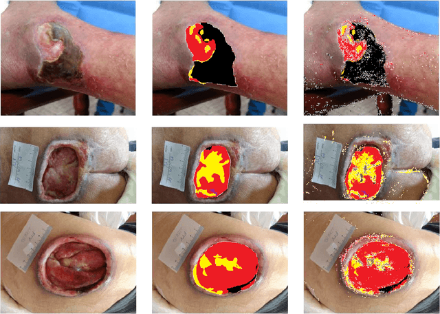 Figure 4 for ComplexWoundDB: A Database for Automatic Complex Wound Tissue Categorization