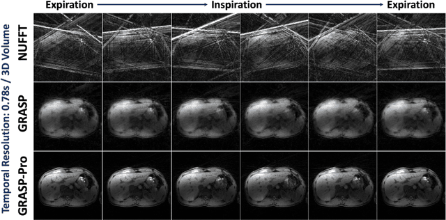Figure 3 for 4D Real-Time GRASP MRI at Sub-Second Temporal Resolution
