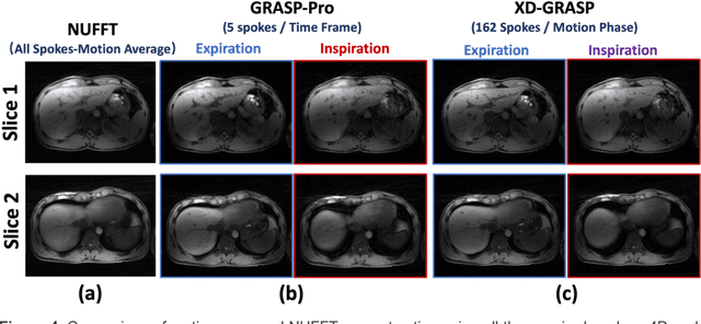 Figure 4 for 4D Real-Time GRASP MRI at Sub-Second Temporal Resolution