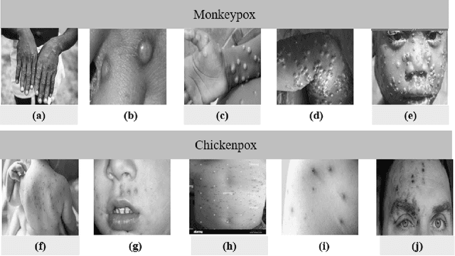 Figure 2 for Monkeypox Image Data collection